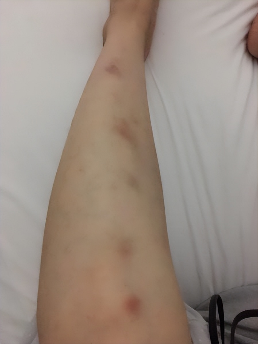 清肾丸治疗紫癜,紫癜针灸治疗