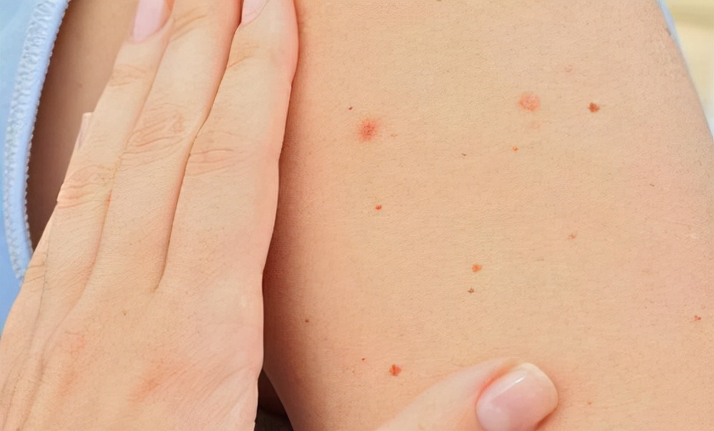 皮肤上出现小红点和痣该怎么检查,警惕皮肤上小红痣