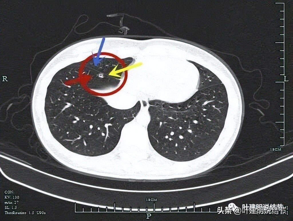 成立肺癌诊疗一体化中心,构建肺癌精准诊疗生态圈