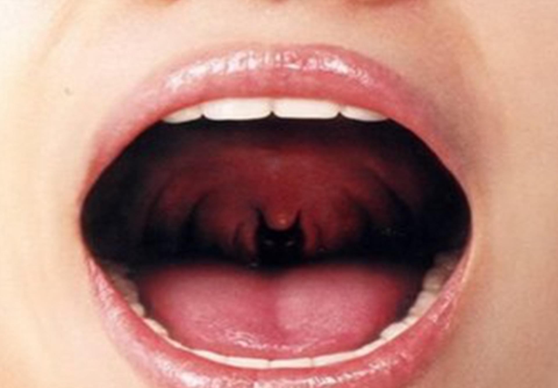 喉癌和鼻咽癌的发病率,与喉癌有关的因素