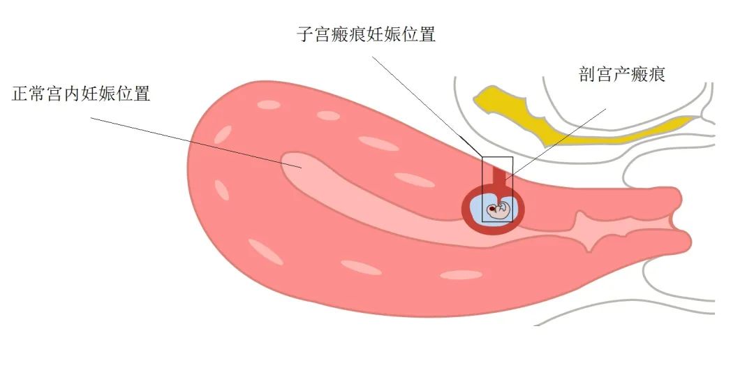 科普瘢痕修复重新缝合,瘢痕妊娠保守治疗成功率高吗