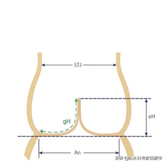 最先进的主动脉瓣二瓣叶畸形修复术（2020版）