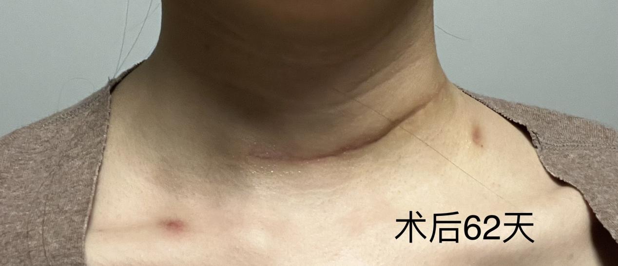 甲状腺癌手术全切疤痕多久能消除,甲状腺癌全切手术后的真实感受