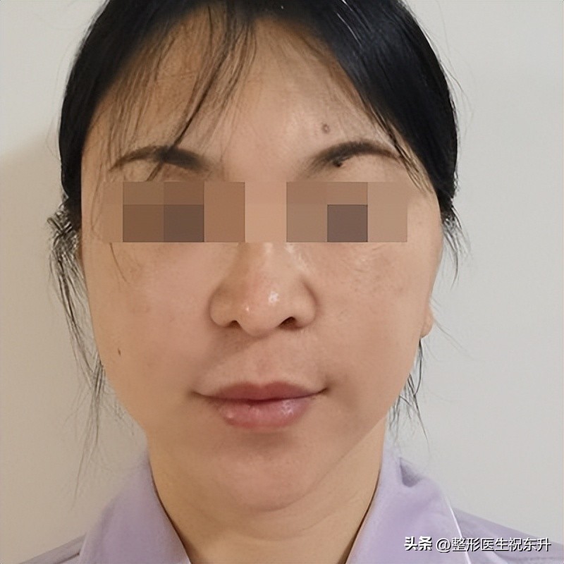 拉皮手术有没有后遗症,拉皮手术的后遗症太厉害了怎么办