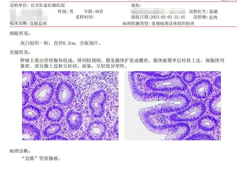肠镜查出管状腺瘤是怎么回事,肠镜查出管状腺瘤是什么