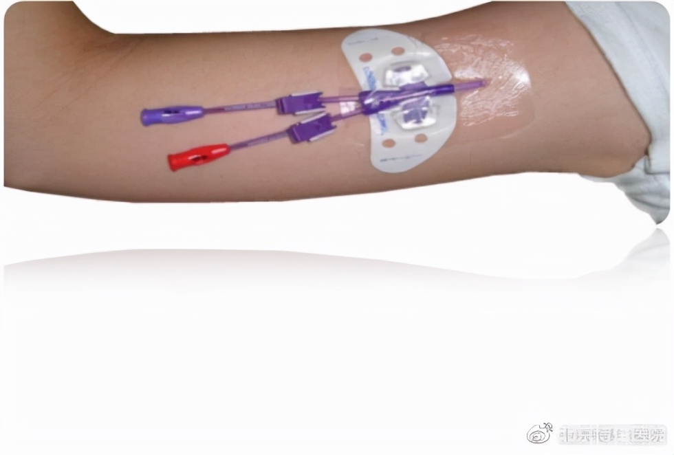 不扎针的输液管,不扎留置针静脉输液