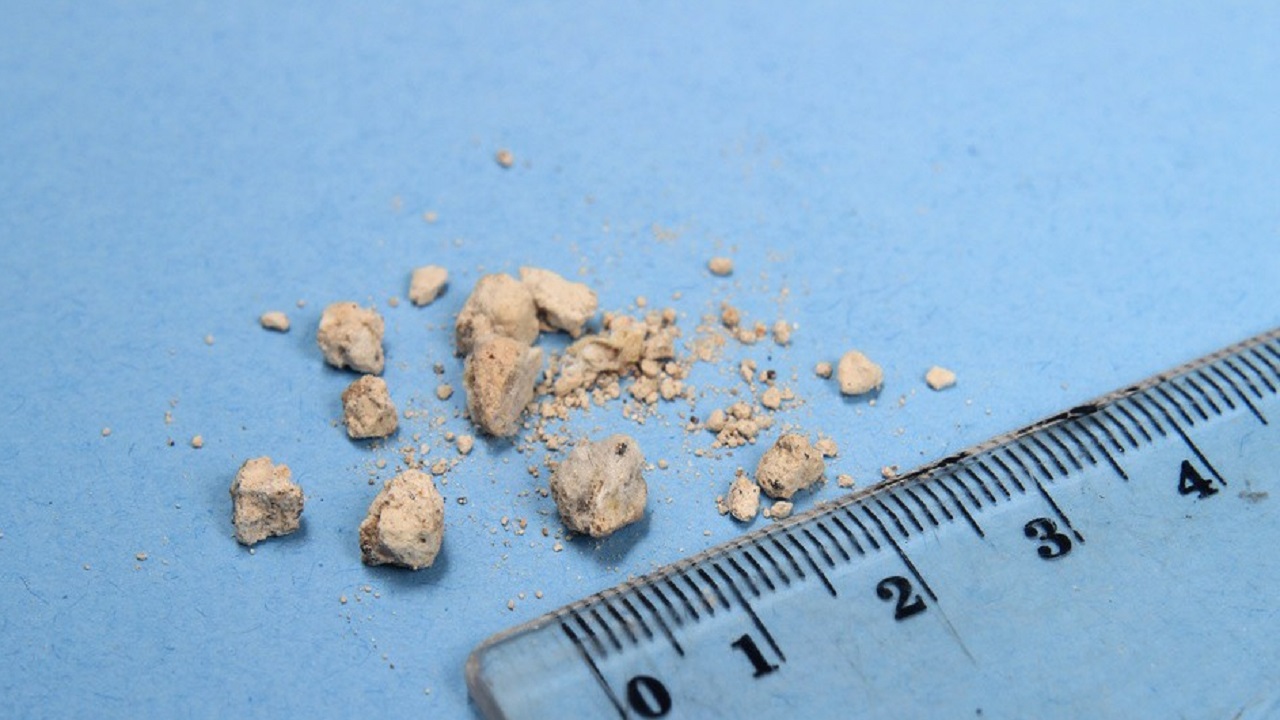 65小伙过量喝奶茶患近10种疾病,一男子因常年喝浓茶患病