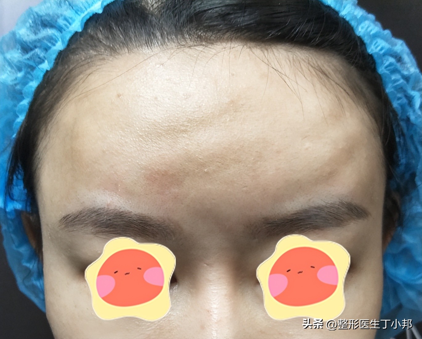 脂肪填充整形知识,脂肪填充修复失败