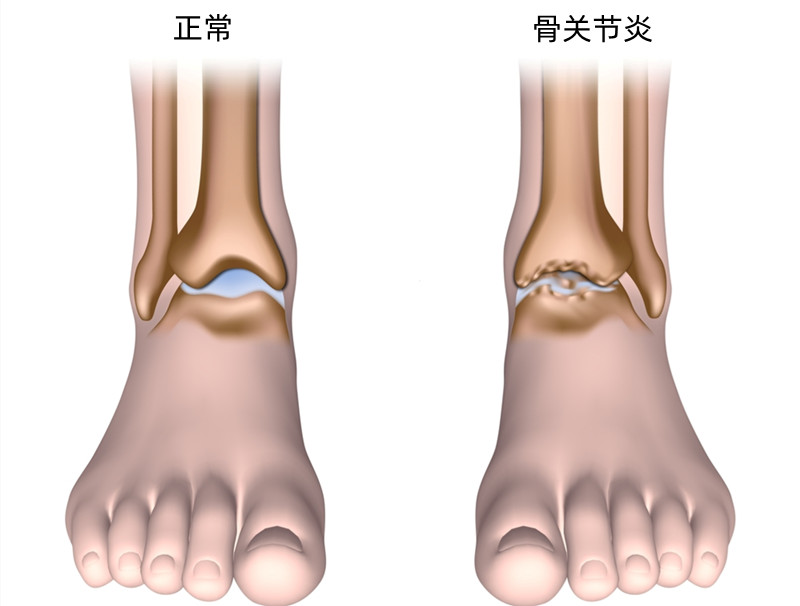 走路脚踝发出清脆响声突然很疼,走路脚踝发出清脆响声