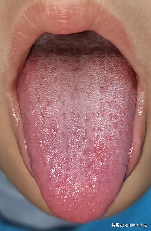 小儿口水多也是疳积的症状吗,小儿口水多