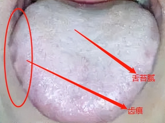 白天困晚上困什么方法治疗,十几岁脾虚湿困的最佳治疗方法