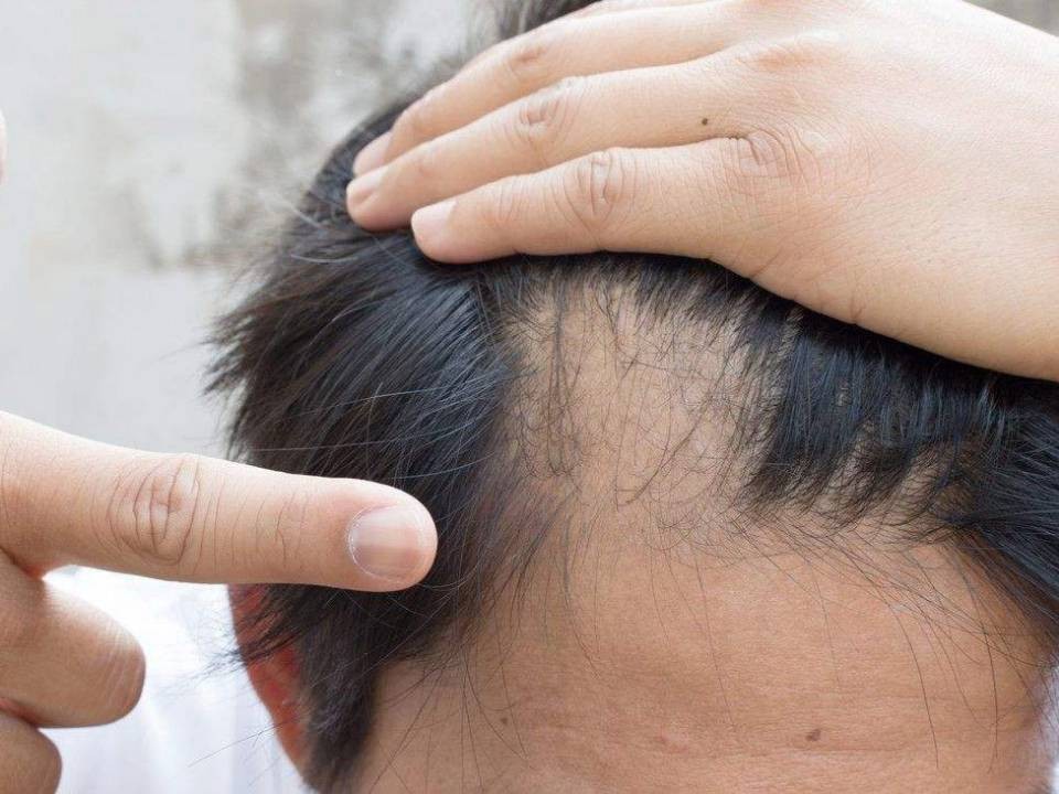 脱发为什么都是从头顶先秃,脱发为什么先从头顶脱