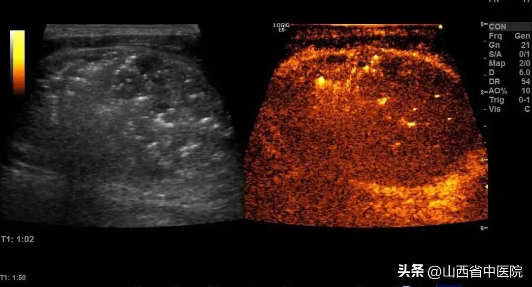 山西省肿瘤医院甲状腺结节消融,江苏省人民医院甲状腺结节消融术