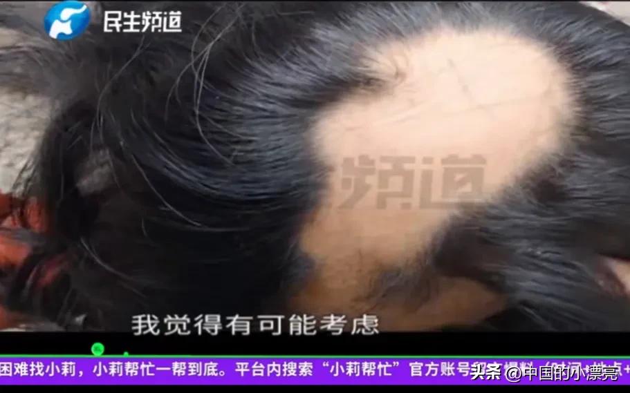 13岁女孩拔自己的头发,拔发癖的女孩