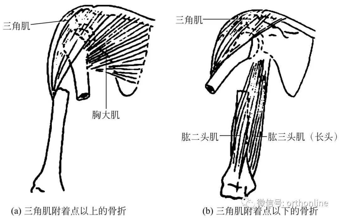 股骨干骨折保守治疗多久恢复,肱骨干骨折恢复过程中的四大禁忌