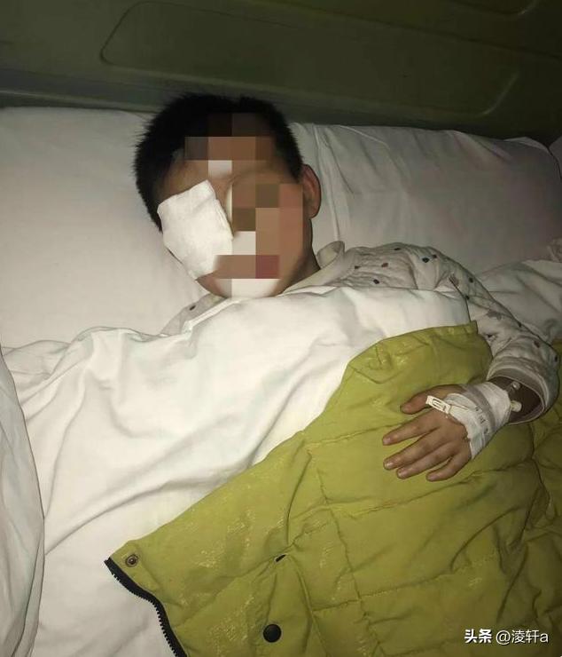 20分钟男童眼球融化,八岁男童眼球瞬间被融化