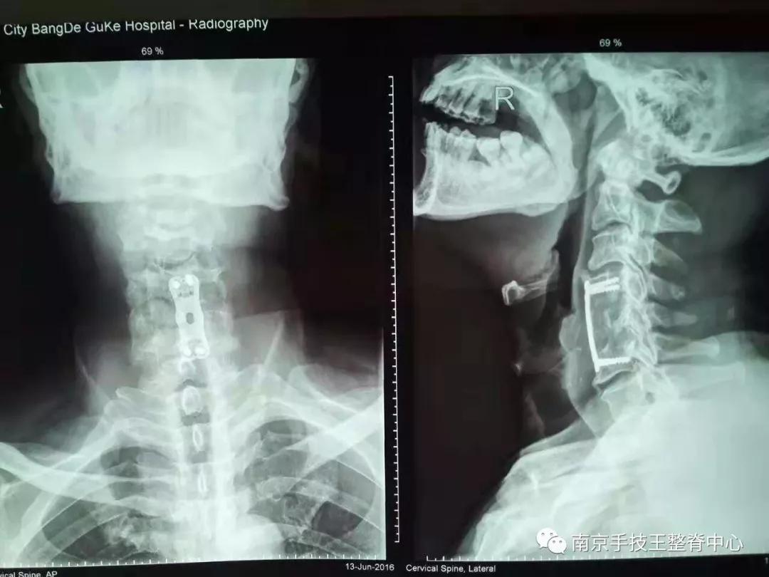 脊髓型颈椎病自愈的最快方法,脊髓型颈椎病的克星