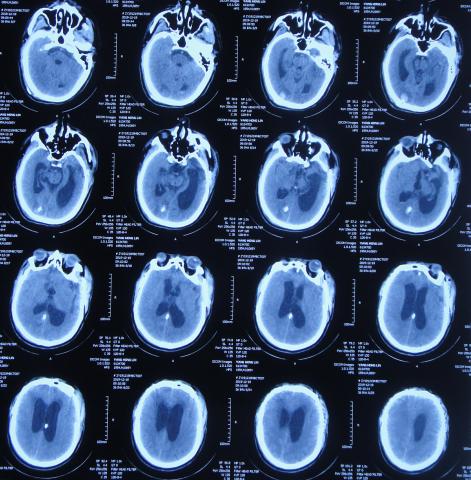 脑外伤后硬膜下积液颅骨修补,颅骨修复手术失败导致脑积水