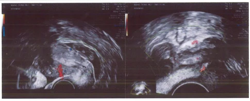 异位妊娠自己出血了还用做手术嘛,不是经期出血的原因要什么时候查