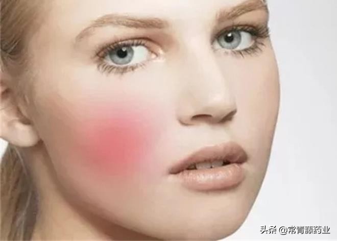 脸蛋泛红不痛不痒是怎么回事,玫瑰痤疮脸上泛红怎么治疗