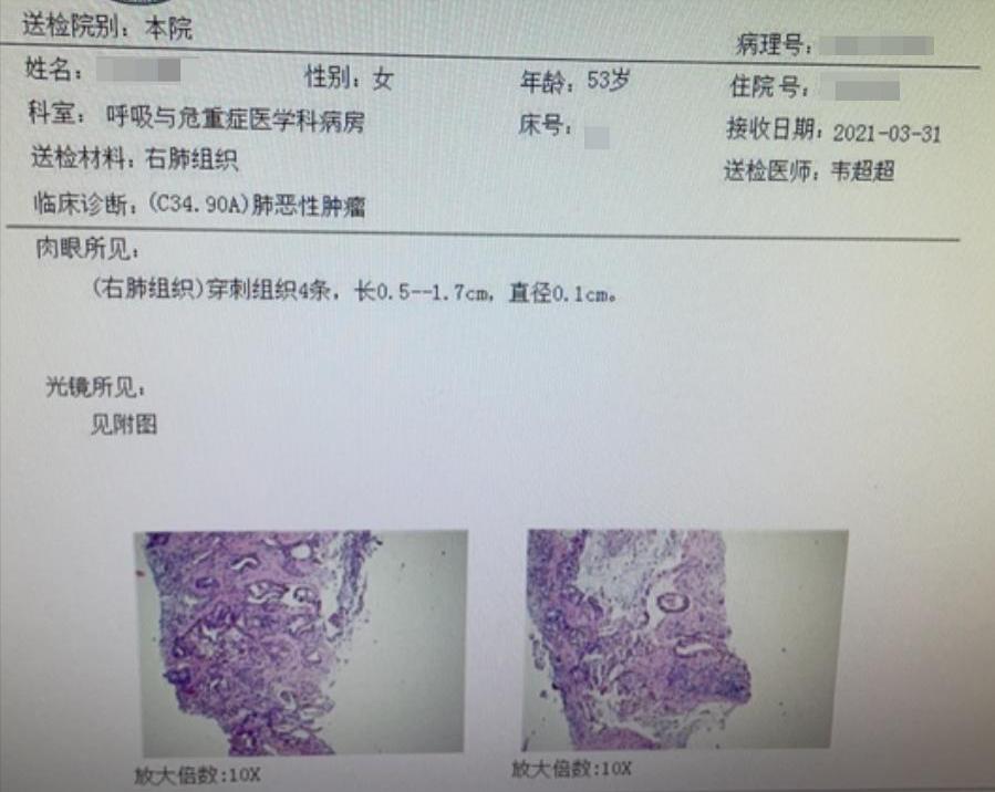 肺癌穿刺活检会引起癌细胞扩散吗,肺癌穿刺手术全过程
