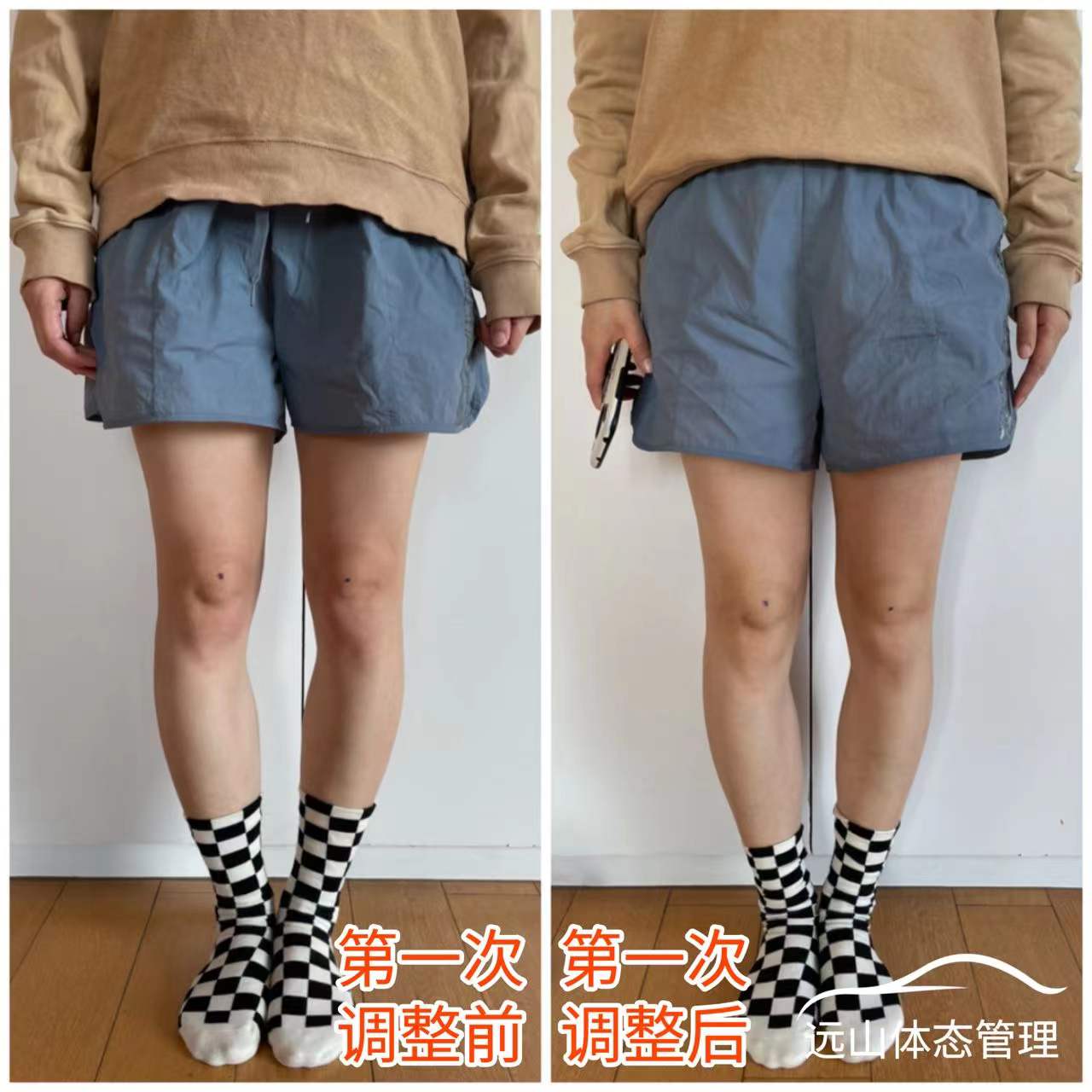 o型腿案例,宝妈o型腿