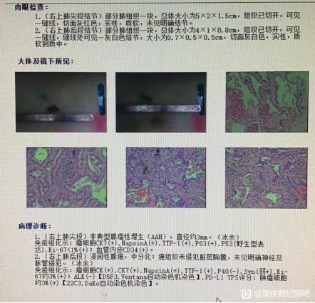肺结节与肺纤维灶一样吗,肺结节和肺内淋巴结一样吗