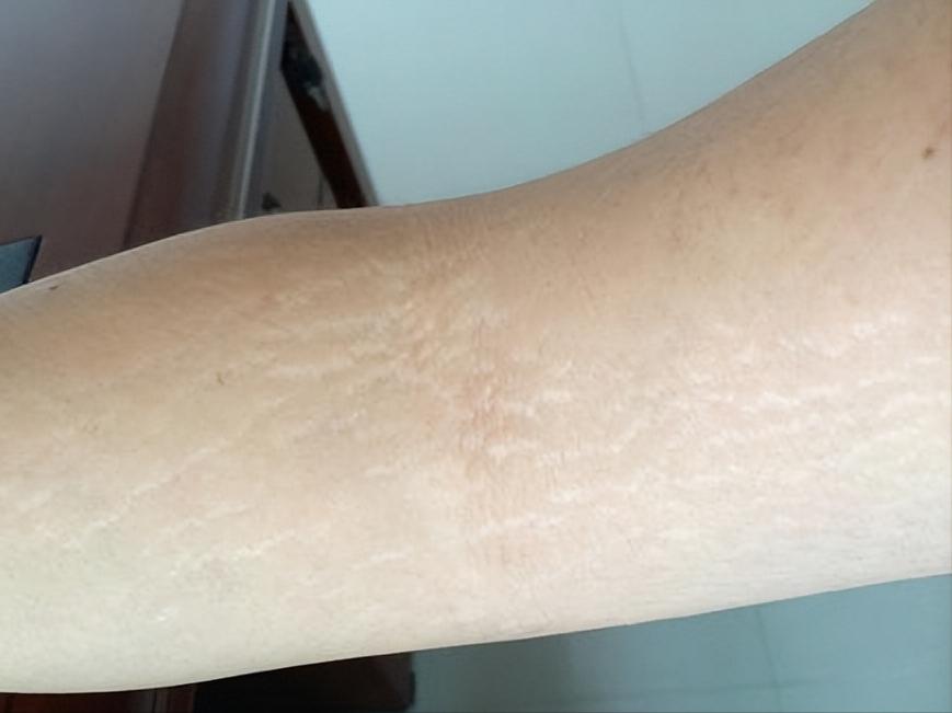 怎么消肥胖纹？吉首俪人教你