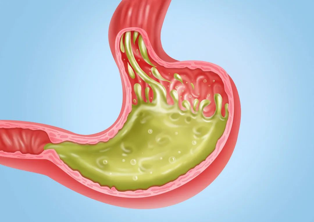 打嗝烧心反酸食道灼热怎么缓解,总是烧心有什么小偏方