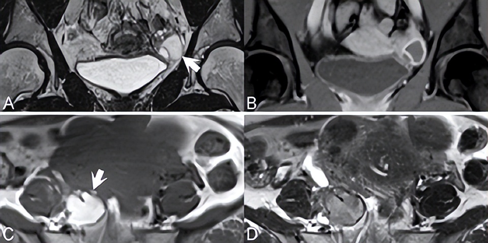 卵巢良性病变mri诊断思路,核磁共振可以看出卵巢病变吗
