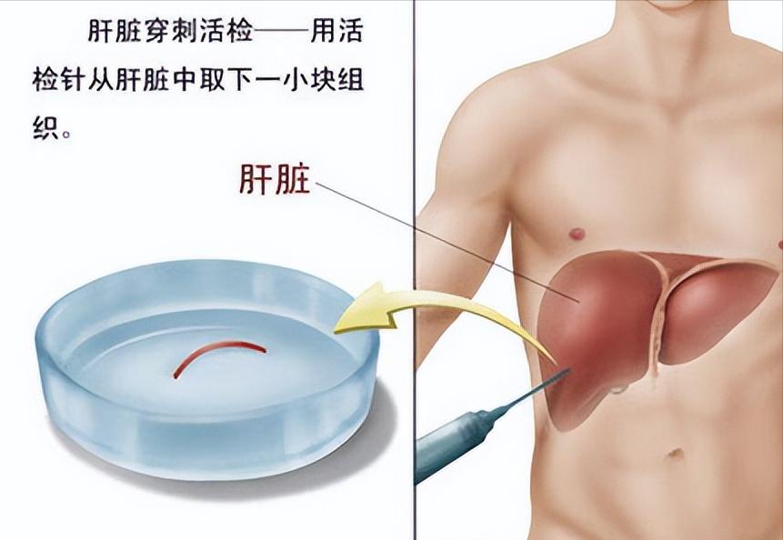 女生31岁乙肝肝硬化早期能活多久,43岁患上乙肝肝硬化还能活几年
