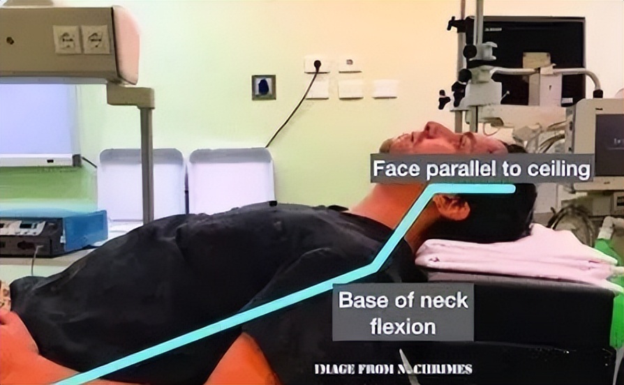 治疗插管,气管插管术的具体步骤及注意事项