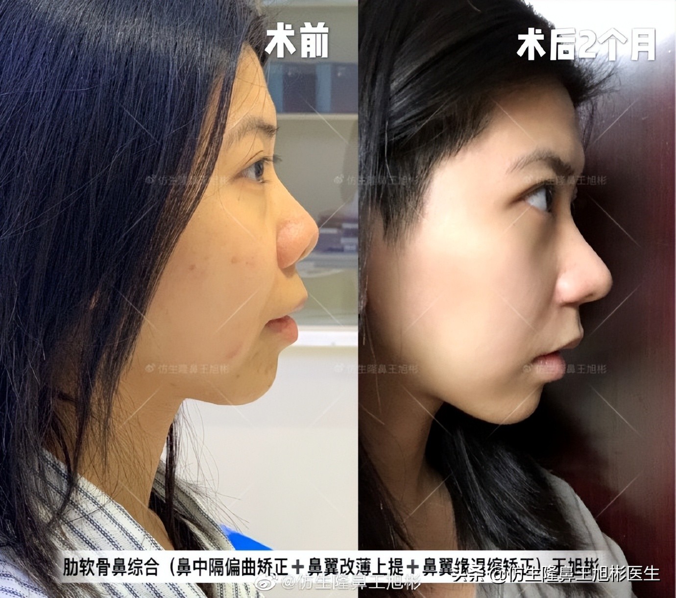 可以只做鼻头不放假体吗,只做鼻头鼻翼缩小手术多少钱