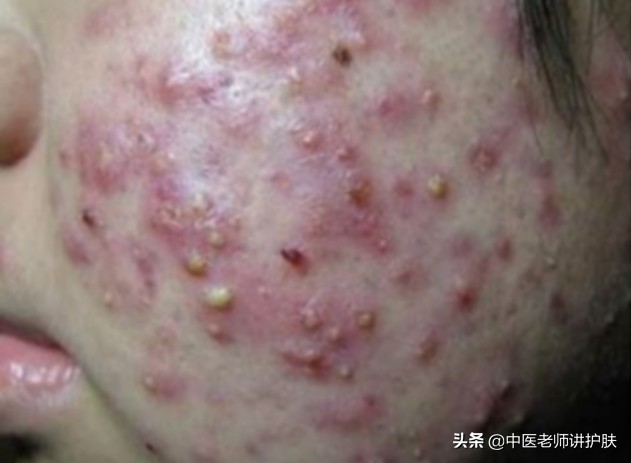 激素依赖性皮炎的发病机制,什么是激素依赖性皮炎怎么治疗