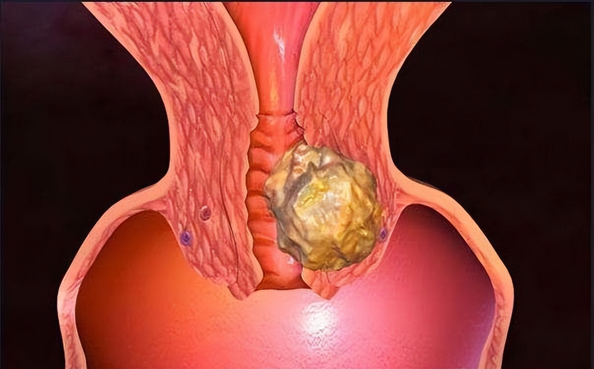宫颈癌多是拖出来的,得了宫颈癌身体有五个部位有征兆