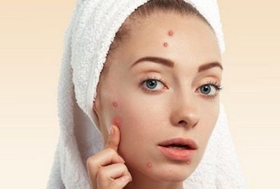 如何祛除脸上痘坑痘印,脸上的痘印怎么祛除