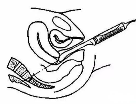 hpv做阴道b超能看出问题吗,阴道b超最早多久可以看出孕囊