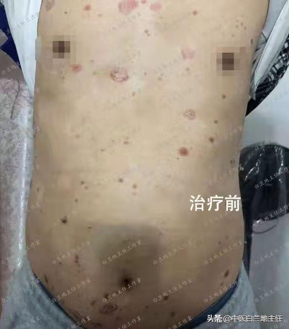 有关银屑病的故事,中医治疗银屑病故事