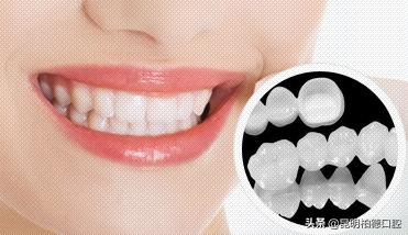 牙齿掉了一半做烤瓷牙全过程,关于牙齿烤瓷牙的一些小事情