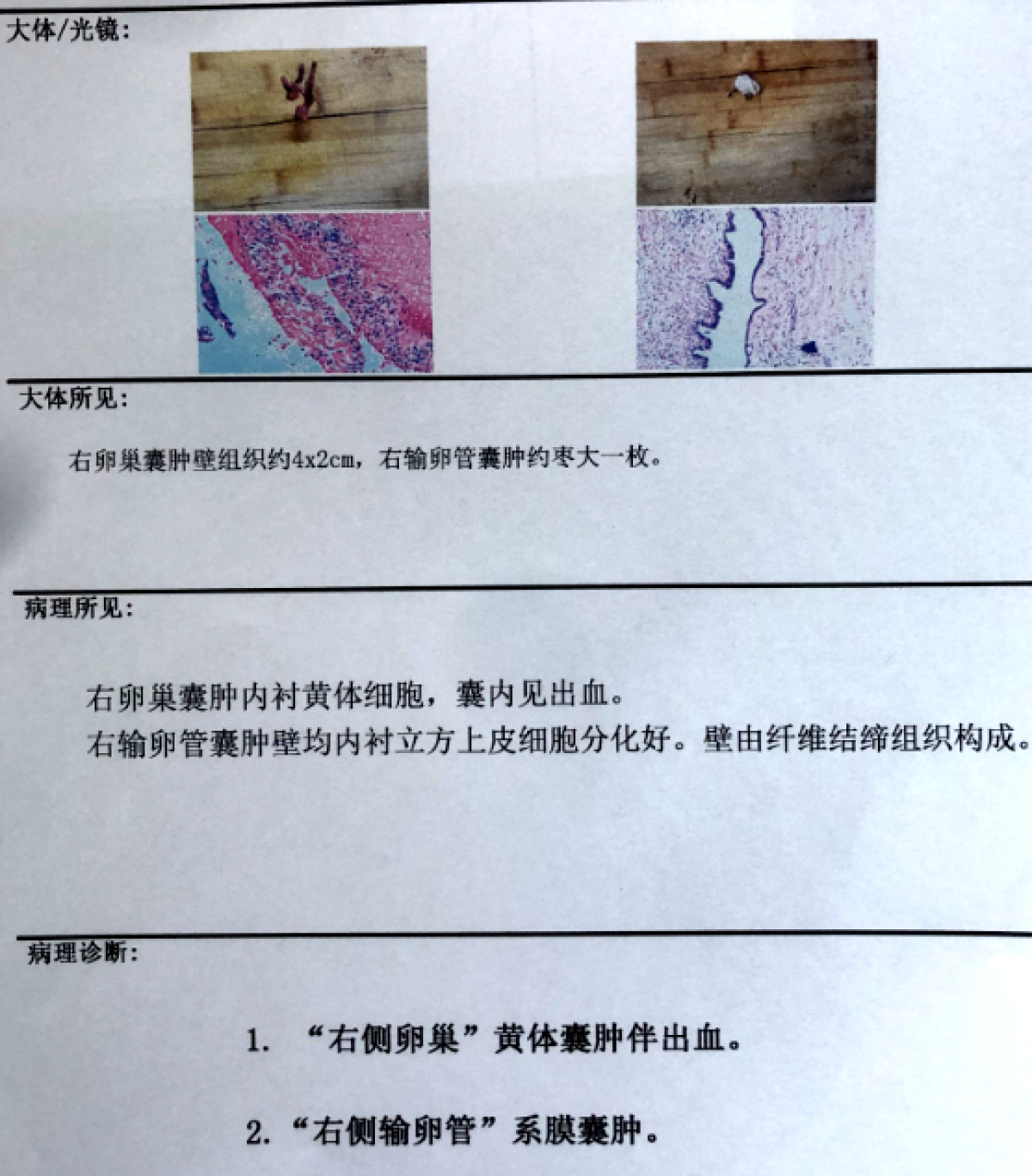 卵巢囊肿孕妇怎么做手术,妇科卵巢囊肿微创腹腔镜手术