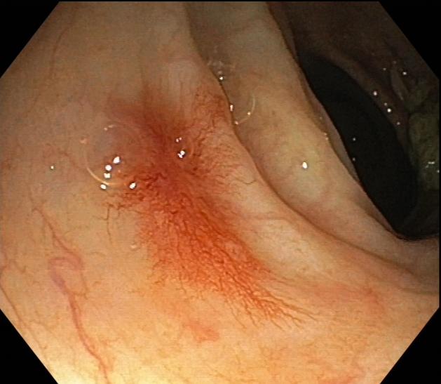 肠道内惊现蜘蛛痣？