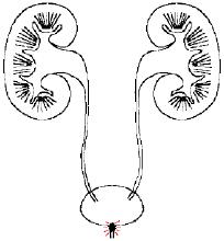 输尿管结石什么情况下需要碎石,输尿管结石的最佳治疗方法有哪些