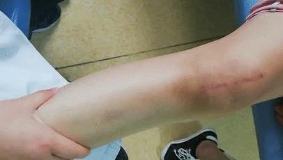 膝关节疼痛或外伤，做完手术在床上静养三个月就可以活动如初了？