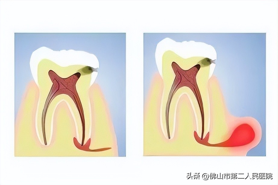 牙痛怎么快速止痛大人用花椒,生姜和花椒止牙痛