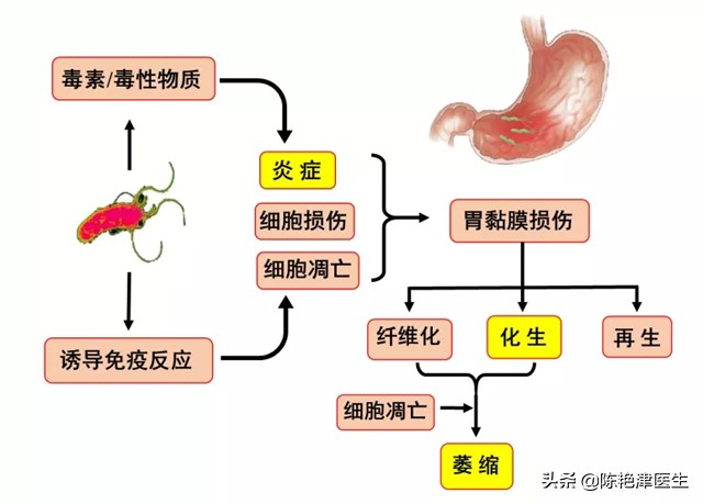 胃癌最大的祸根是幽门螺杆菌，想要彻底杀菌，记住3个办法