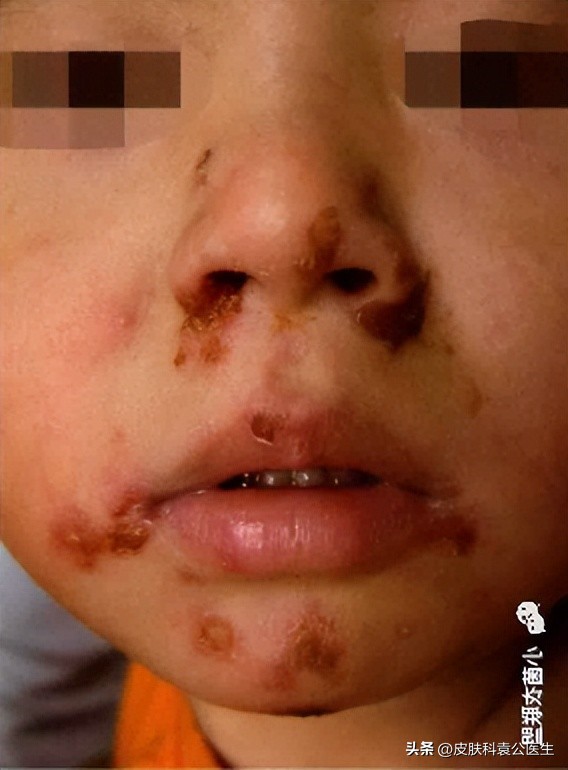 皮肤病忌口发物都包括牛奶吗,发物忌口期间吃什么比较好