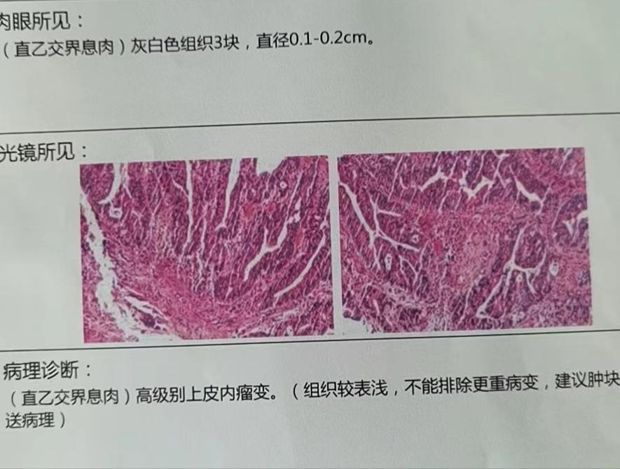 喷射状的便血是痔疮还是肠癌,便血怎么判断是痔疮肛裂还是肠癌