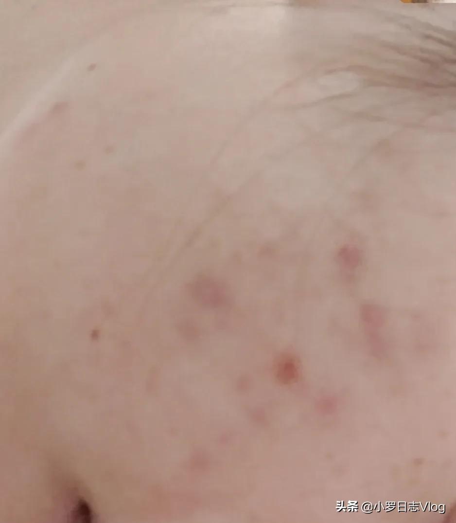 痘痘消了毛孔还是粗大怎么办,痘痘毛孔粗大如何改善去角质