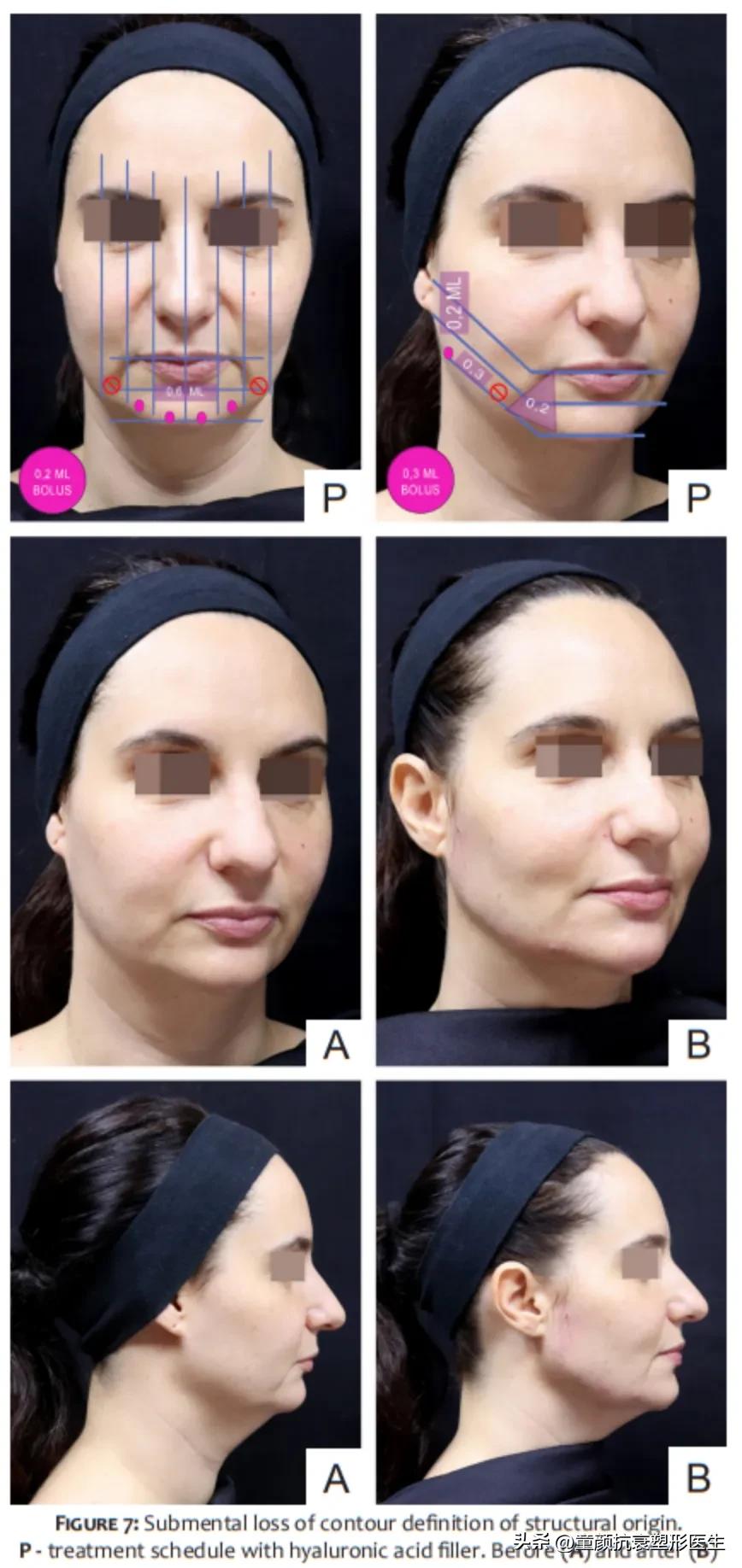 抽脂针瘦脸,抽脂溶脂针