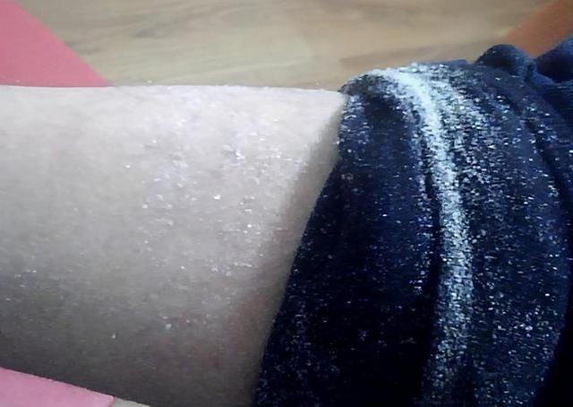 冬天来了皮肤干燥脱衣服有皮屑,冬天皮肤很干燥全是皮屑